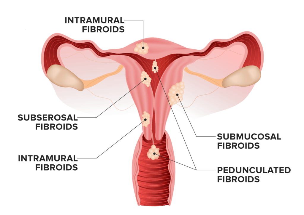 Illustration of different types of fibroids in the uterus