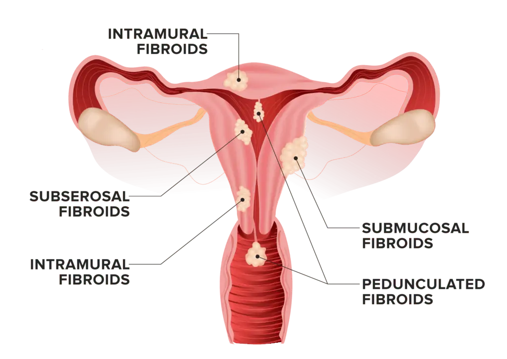 Illustration of different types of fibroids in the uterus